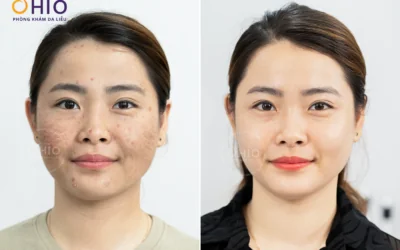 TRỊ SẸO RỖ KHÔNG CẦN PHẪU THUẬT BẰNG CÔNG NGHỆ PULSE SCAR - Phòng khám da liễu OHIO TRỊ SẸO RỖ KHÔNG CẦN PHẪU THUẬT BẰNG CÔNG NGHỆ PULSE SCAR