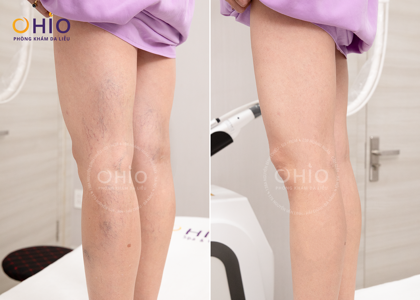 Giãn mao mạch điều trị dứt điểm với tổ hợp Công nghệ laser xung dài - Phòng khám da liễu OHIO Giãn mao mạch điều trị dứt điểm với tổ hợp Công nghệ laser xung dài