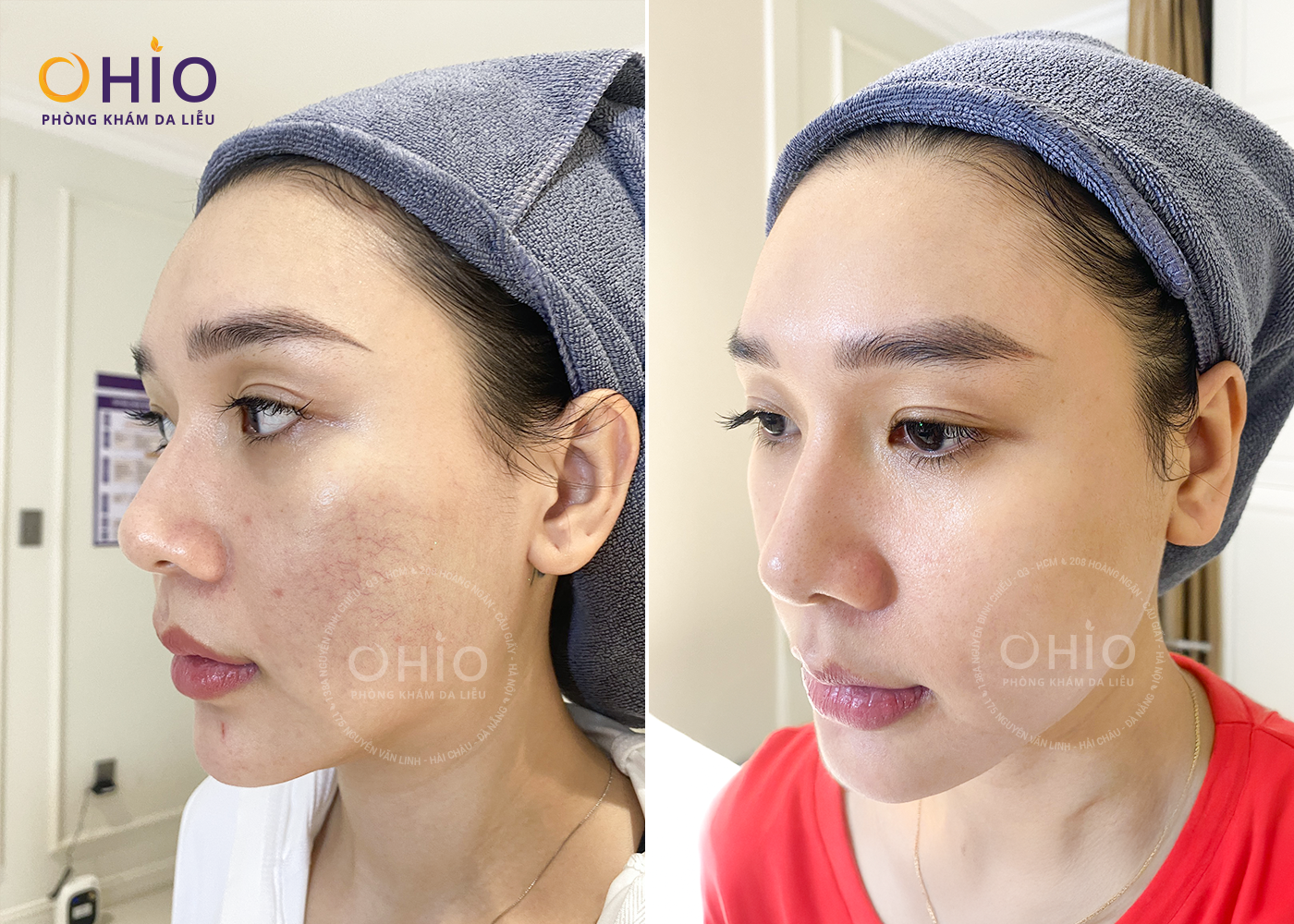 Giãn mao mạch điều trị dứt điểm với tổ hợp Công nghệ laser xung dài - Phòng khám da liễu OHIO Giãn mao mạch điều trị dứt điểm với tổ hợp Công nghệ laser xung dài