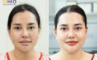 TRỊ SẸO RỖ KHÔNG CẦN PHẪU THUẬT BẰNG CÔNG NGHỆ PULSE SCAR - Phòng khám da liễu OHIO TRỊ SẸO RỖ KHÔNG CẦN PHẪU THUẬT BẰNG CÔNG NGHỆ PULSE SCAR