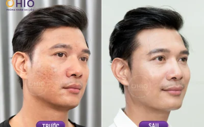 TRỊ SẸO RỖ KHÔNG CẦN PHẪU THUẬT BẰNG CÔNG NGHỆ PULSE SCAR - Phòng khám da liễu OHIO TRỊ SẸO RỖ KHÔNG CẦN PHẪU THUẬT BẰNG CÔNG NGHỆ PULSE SCAR