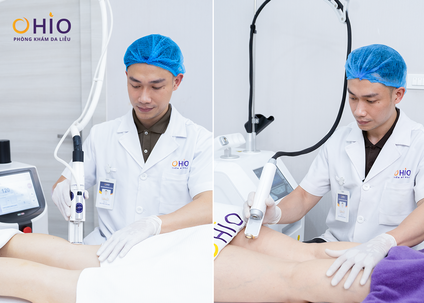 Giãn mao mạch chân đùi: Nguyên nhân và cách điều trị - Phòng khám da liễu OHIO Điều trị giãn mao mạch bằng tổ hợp Laser xung dài