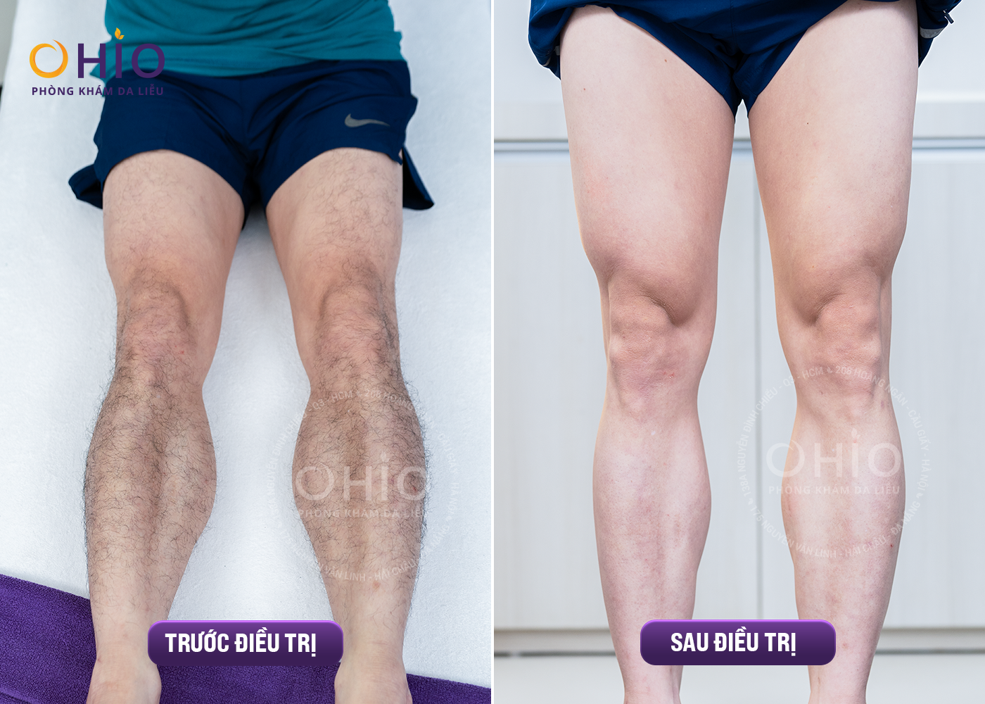 TRIỆT LÔNG TOÀN THÂN CHO NAM GIỚI Ở ĐÂU TỐT NHẤT? - Phòng khám da liễu OHIO Kết quả triệt lông tại thẩm mỹ OHIO