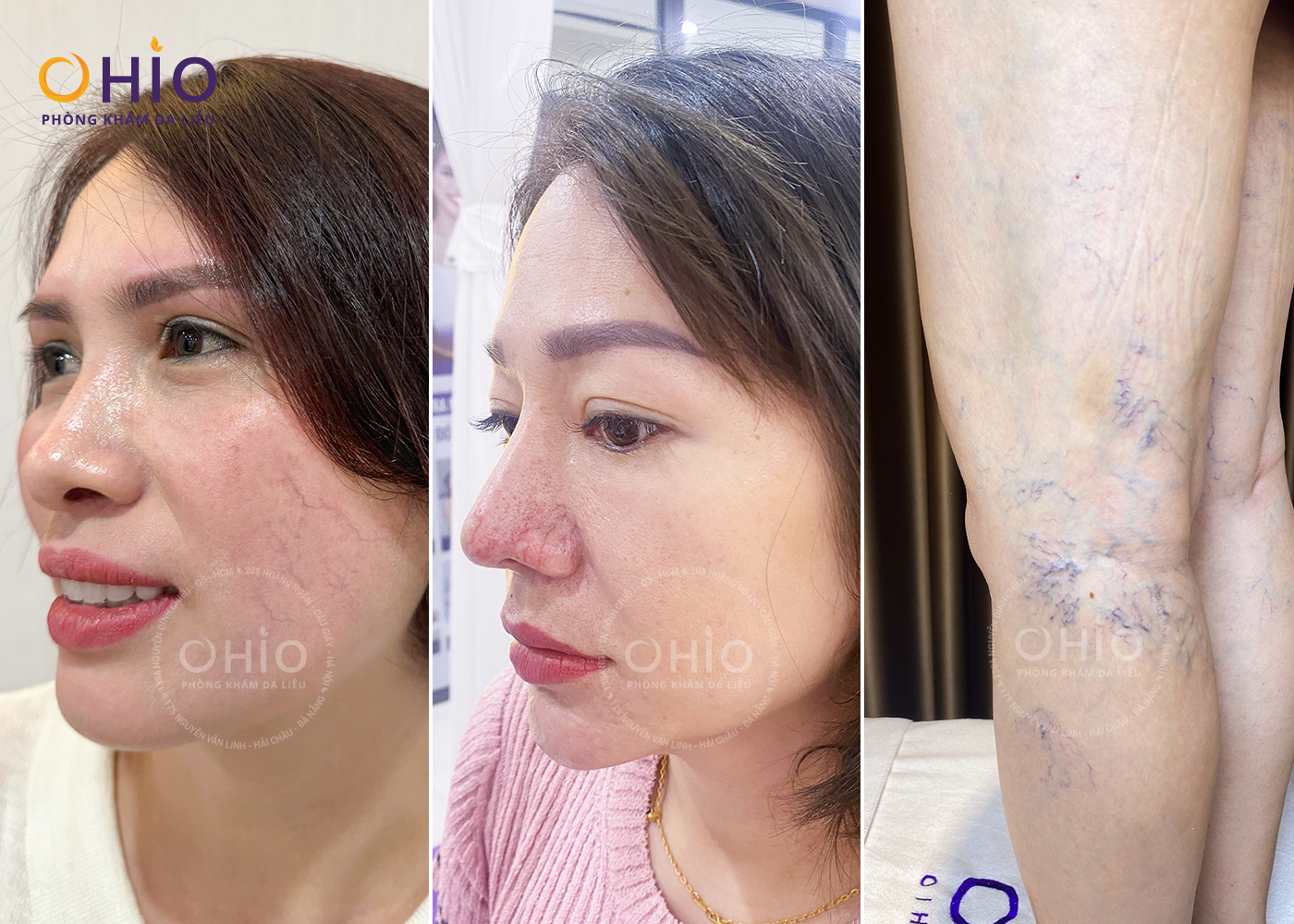 Điều trị giãn mao mạch bằng laser có đắt không? - Phòng khám da liễu OHIO Điều trị giãn mao mạch bằng laser có đắt không?