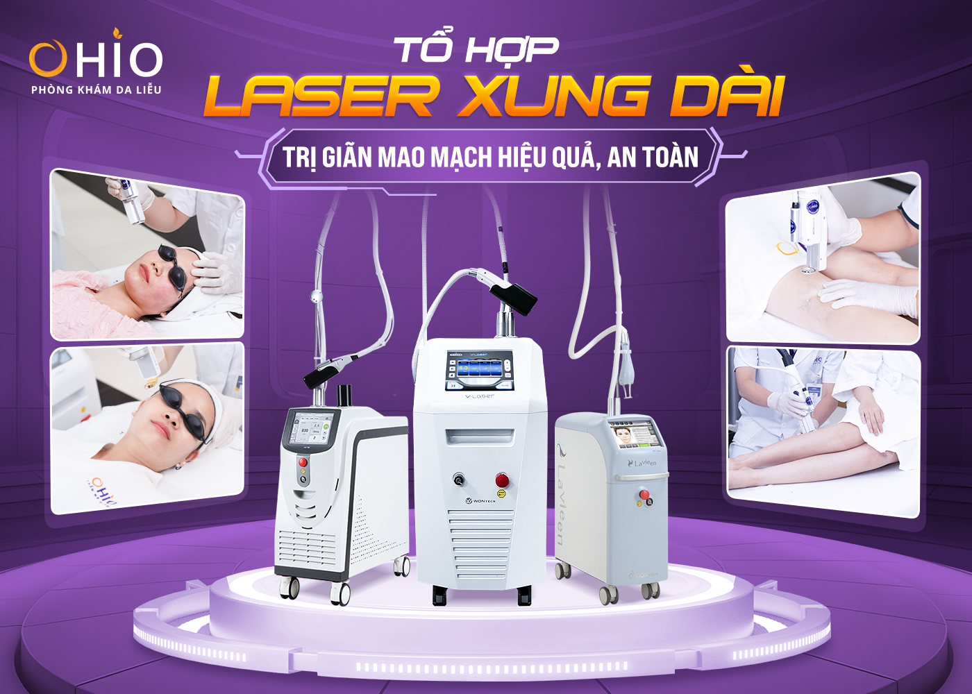 Giãn mao mạch điều trị dứt điểm với tổ hợp Công nghệ laser xung dài - Phòng khám da liễu OHIO Giãn mao mạch điều trị