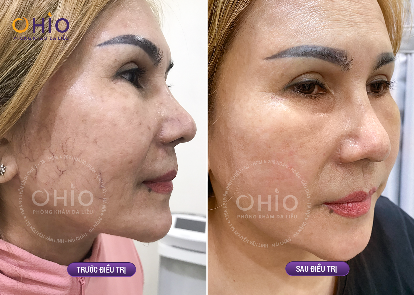 Điều trị giãn mao mạch bằng laser có đắt không? - Phòng khám da liễu OHIO Điều trị giãn mao mạch bằng laser có đắt không?