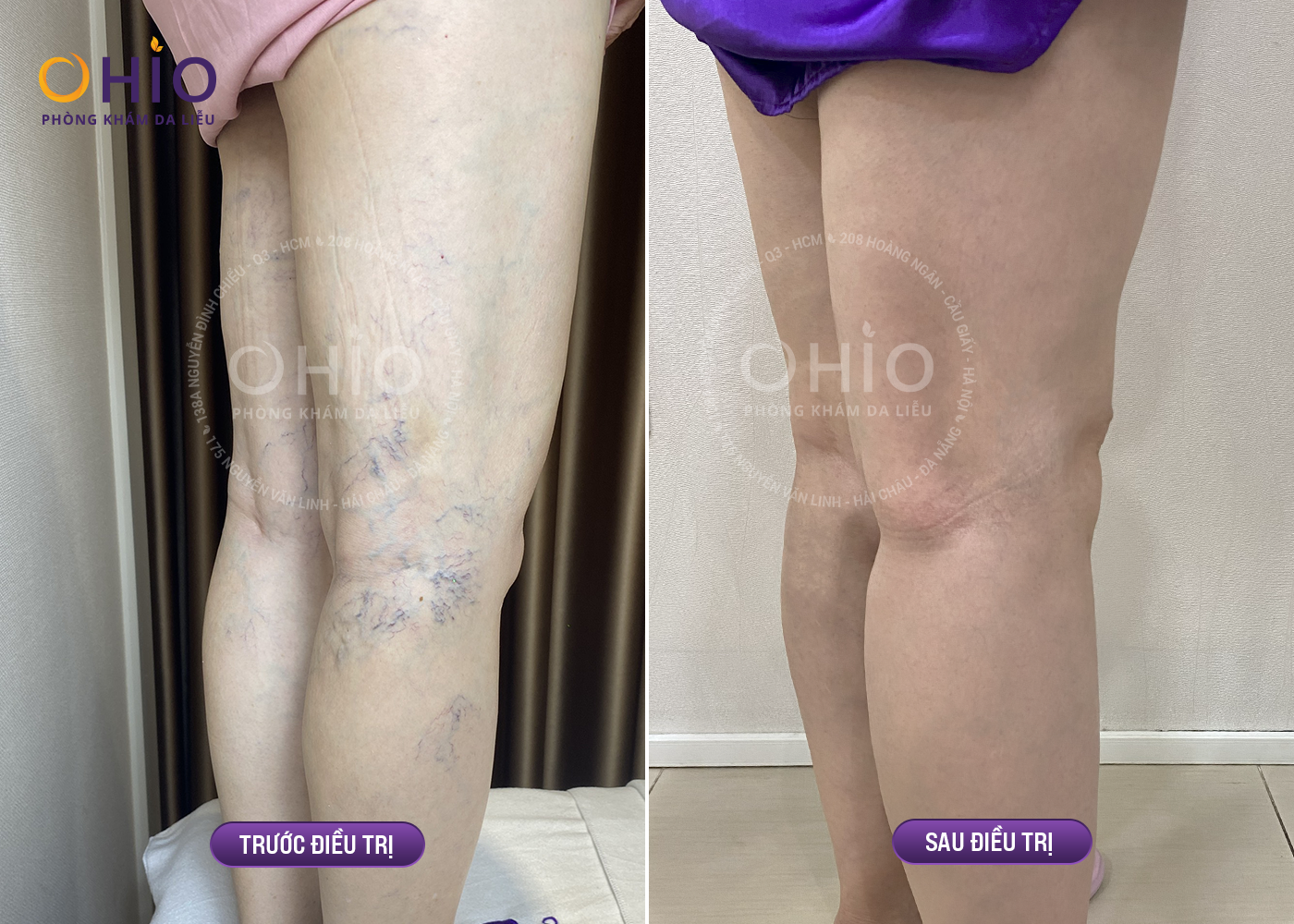 Điều trị giãn mao mạch bằng laser có đắt không? - Phòng khám da liễu OHIO Điều trị giãn mao mạch bằng laser có đắt không?
