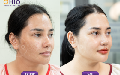 Lo Sẹo Rỗ Tái Phát? Tổ Hợp Công Nghệ Pulse Scar Giúp Làn Da Mịn Màng Lâu Dài - Phòng khám da liễu OHIO sẹo rỗ