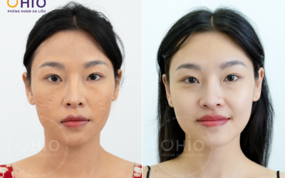 phương pháp điều trị sẹo rỗ