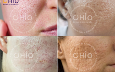 trị sẹo rỗ