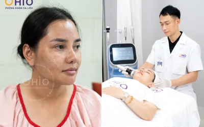 Bác Sĩ Da liễu Nguyễn Thế Anh: “Điều trị sẹo rỗ phải có phác đồ phù hợp và cần dựa trên cơ sở khoa học” - Phòng khám da liễu OHIO Bác Sĩ Da liễu Nguyễn Thế Anh: “Điều trị sẹo rỗ phải có phác đồ phù hợp và cần dựa trên cơ sở khoa học”