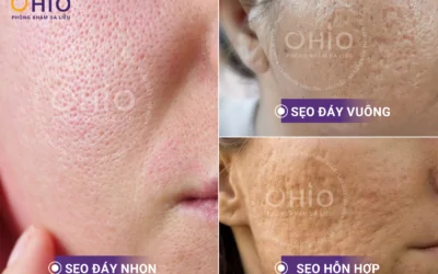 OHIO Dẫn Đầu Xu Hướng Điều Trị Sẹo Rỗ: Sức Mạnh Từ Tổ Hợp Đa Công Nghệ - Phòng khám da liễu OHIO tiên phong trong điều trị sẹo rỗ