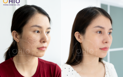 OHIO Dẫn Đầu Xu Hướng Điều Trị Sẹo Rỗ: Sức Mạnh Từ Tổ Hợp Đa Công Nghệ - Phòng khám da liễu OHIO điều trị sẹo rỗ