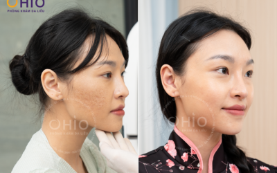 OHIO Dẫn Đầu Xu Hướng Điều Trị Sẹo Rỗ: Sức Mạnh Từ Tổ Hợp Đa Công Nghệ - Phòng khám da liễu OHIO OHIO Dẫn Đầu Xu Hướng Điều Trị Sẹo Rỗ: Sức Mạnh Từ Tổ Hợp Đa Công Nghệ