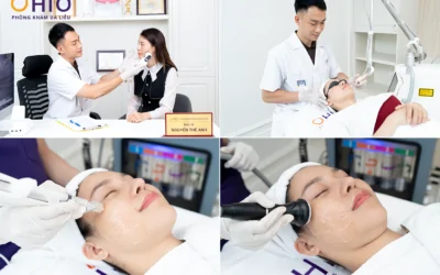 OHIO Dẫn Đầu Xu Hướng Điều Trị Sẹo Rỗ: Sức Mạnh Từ Tổ Hợp Đa Công Nghệ - Phòng khám da liễu OHIO OHIO Dẫn Đầu Xu Hướng Điều Trị Sẹo Rỗ: Sức Mạnh Từ Tổ Hợp Đa Công Nghệ