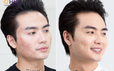 Phòng Khám Da Liễu OHIO: Tiên Phong Trong Điều Trị Sẹo Rỗ Với Công Nghệ Đột Phá
