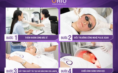 điều trị sẹo rỗ