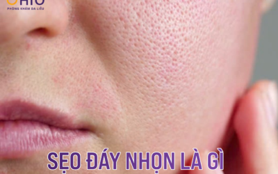 seo đáy nhọn