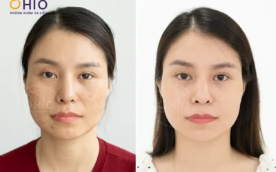 SẸO ĐÁY NHỌN KHÔNG CÒN LÀ NỖI LO: OHIO VƯƠN LÊN TOP ĐẦU VỚI TỔ HỢP CÔNG NGHỆ TRỊ SẸO HIỆN ĐẠI - Phòng khám da liễu OHIO SẸO ĐÁY NHỌN KHÔNG CÒN LÀ NỖI LO: OHIO VƯƠN LÊN TOP ĐẦU VỚI TỔ HỢP CÔNG NGHỆ TRỊ SẸO HIỆN ĐẠI