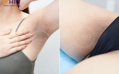 Khi làn da sau sinh bật “tín hiệu cầu cứu” – Hành trình tìm lại sự tự tin của chị Thu Hằng - Phòng khám da liễu OHIO trị thâm