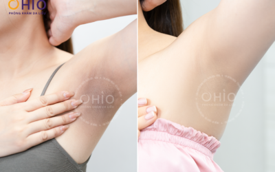 Khi làn da sau sinh bật “tín hiệu cầu cứu” – Hành trình tìm lại sự tự tin của chị Thu Hằng - Phòng khám da liễu OHIO Khi làn da sau sinh bật “tín hiệu cầu cứu” – Hành trình tìm lại sự tự tin của chị Thu Hằng