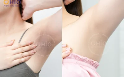 Khi làn da sau sinh bật “tín hiệu cầu cứu” – Hành trình tìm lại sự tự tin của chị Thu Hằng - Phòng khám da liễu OHIO Khi làn da sau sinh bật “tín hiệu cầu cứu” – Hành trình tìm lại sự tự tin của chị Thu Hằng