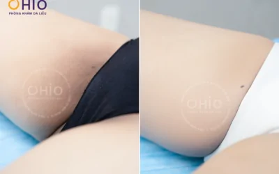 Khi làn da sau sinh bật “tín hiệu cầu cứu” – Hành trình tìm lại sự tự tin của chị Thu Hằng - Phòng khám da liễu OHIO Khi làn da sau sinh bật “tín hiệu cầu cứu” – Hành trình tìm lại sự tự tin của chị Thu Hằng