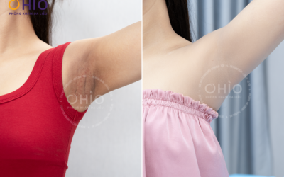 Điều trị thâm da: Giải pháp y khoa lấy lại làn da sáng mịn và tự tin