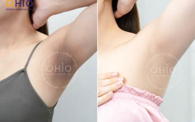 Điều trị thâm da: Giải pháp y khoa lấy lại làn da sáng mịn và tự tin