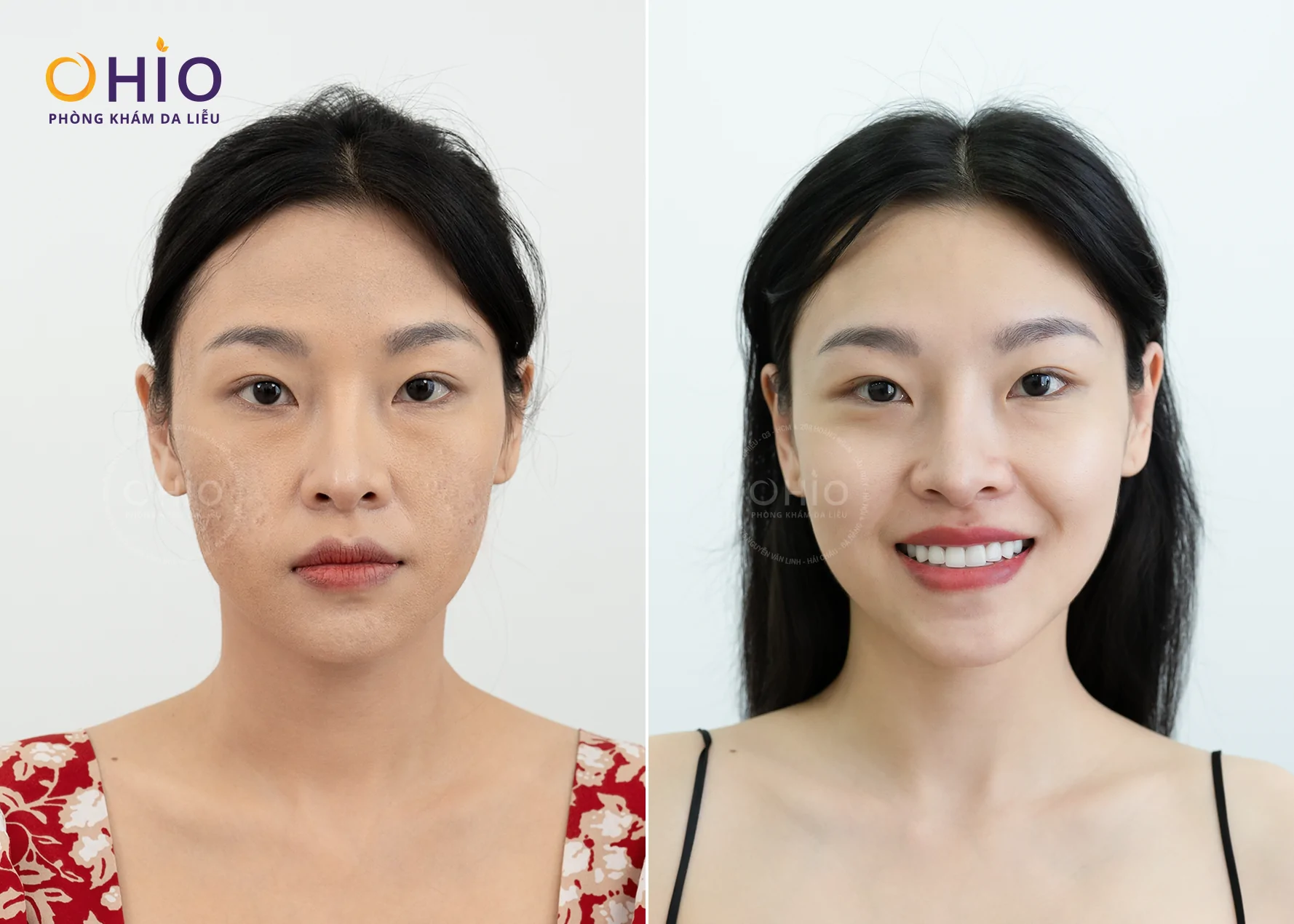OHIO: Đánh Bại Sẹo Rỗ Bằng Sự Kết Hợp Giữa Y Khoa Bệnh Lý Và Thẩm Mỹ Cao Cấp - Phòng khám da liễu OHIO Sẹo Rỗ