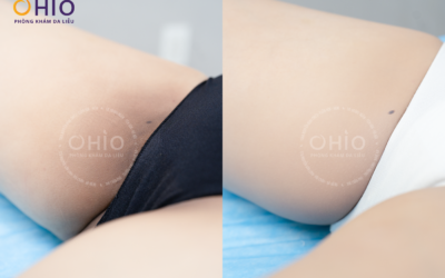 Thâm vùng kín do thói quen mặc đồ bó sát và vệ sinh chưa đúng cách