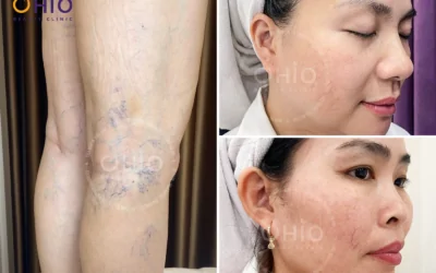 Telangiectasia Treatment with Long-Pulsed Laser Technology – Safe & Effective - Phòng khám da liễu OHIO Telangiectasia Treatment