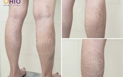 Telangiectasia Treatment with Long-Pulsed Laser Technology – Safe & Effective - Phòng khám da liễu OHIO Telangiectasia Treatment with Long-Pulsed Laser Technology – Safe & Effective