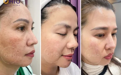 Telangiectasia Treatment with Long-Pulsed Laser Technology – Safe & Effective - Phòng khám da liễu OHIO Telangiectasia Treatment with Long-Pulsed Laser Technology – Safe & Effective
