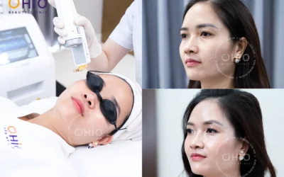 Telangiectasia Treatment with Long-Pulsed Laser Technology – Safe & Effective - Phòng khám da liễu OHIO Telangiectasia Treatment with Long-Pulsed Laser Technology – Safe & Effective