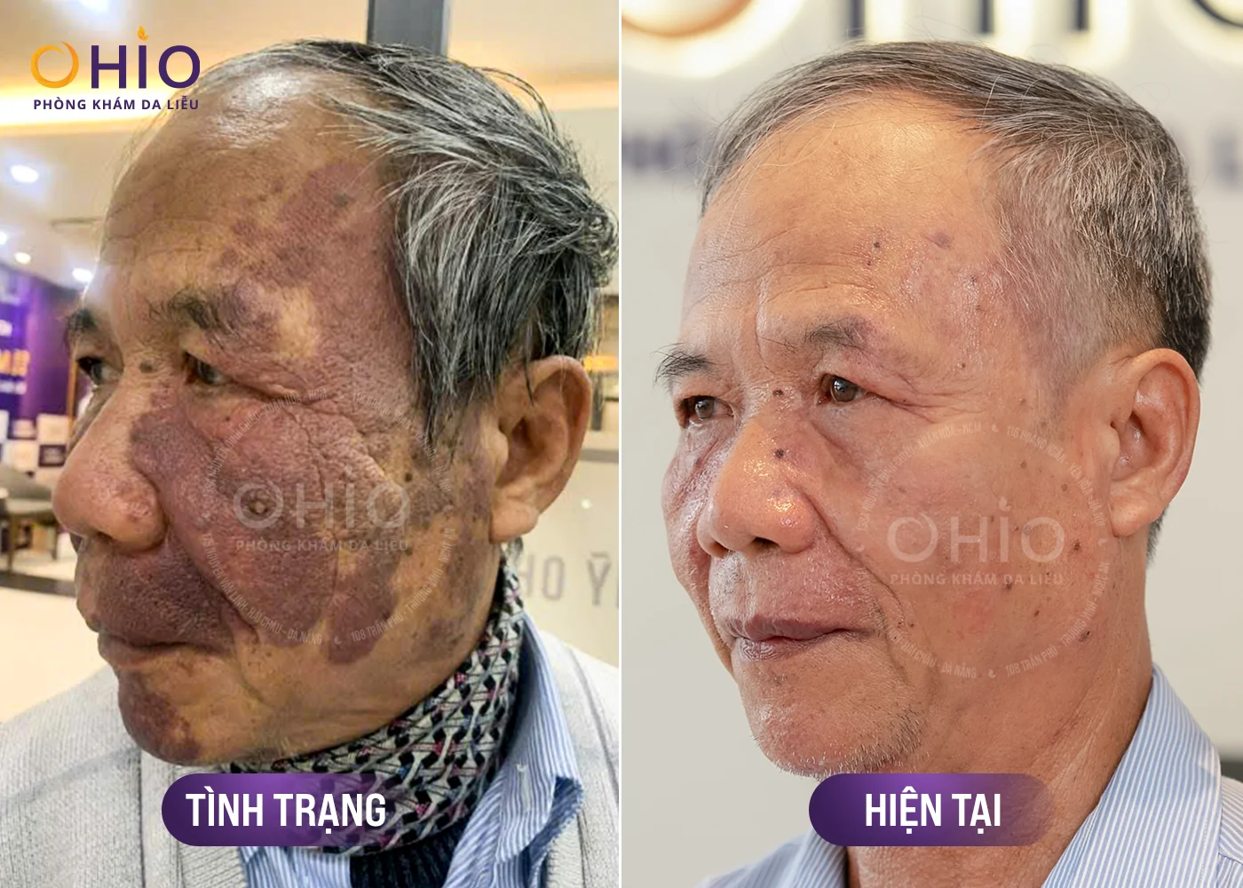 Xóa Sạch Chàm Đỏ, U Máu 70 Năm tại OHIO - Phòng khám da liễu OHIO Xóa sạch chàm đỏ u máu