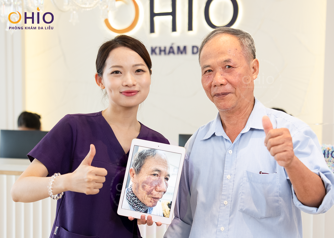 Xóa Sạch Chàm Đỏ, U Máu 70 Năm tại OHIO