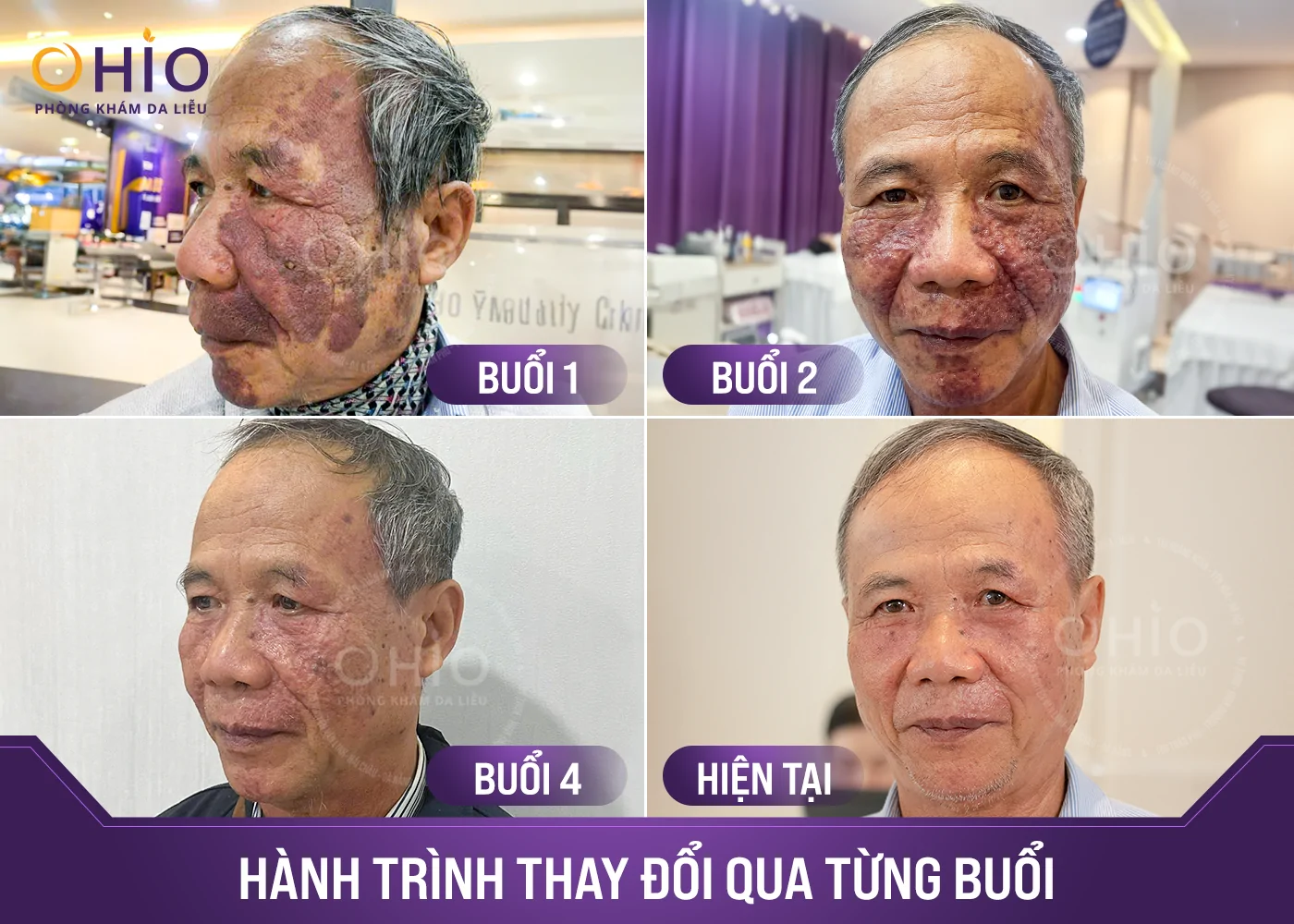 Xóa Sạch Chàm Đỏ, U Máu 70 Năm tại OHIO - Phòng khám da liễu OHIO Xóa Sạch Chàm Đỏ, U Máu 70 Năm tại OHIO