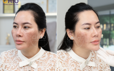 Tạm biệt tăng sắc tố sau 7 năm — Hành trình tìm lại chính mình của chị Thu Hoài