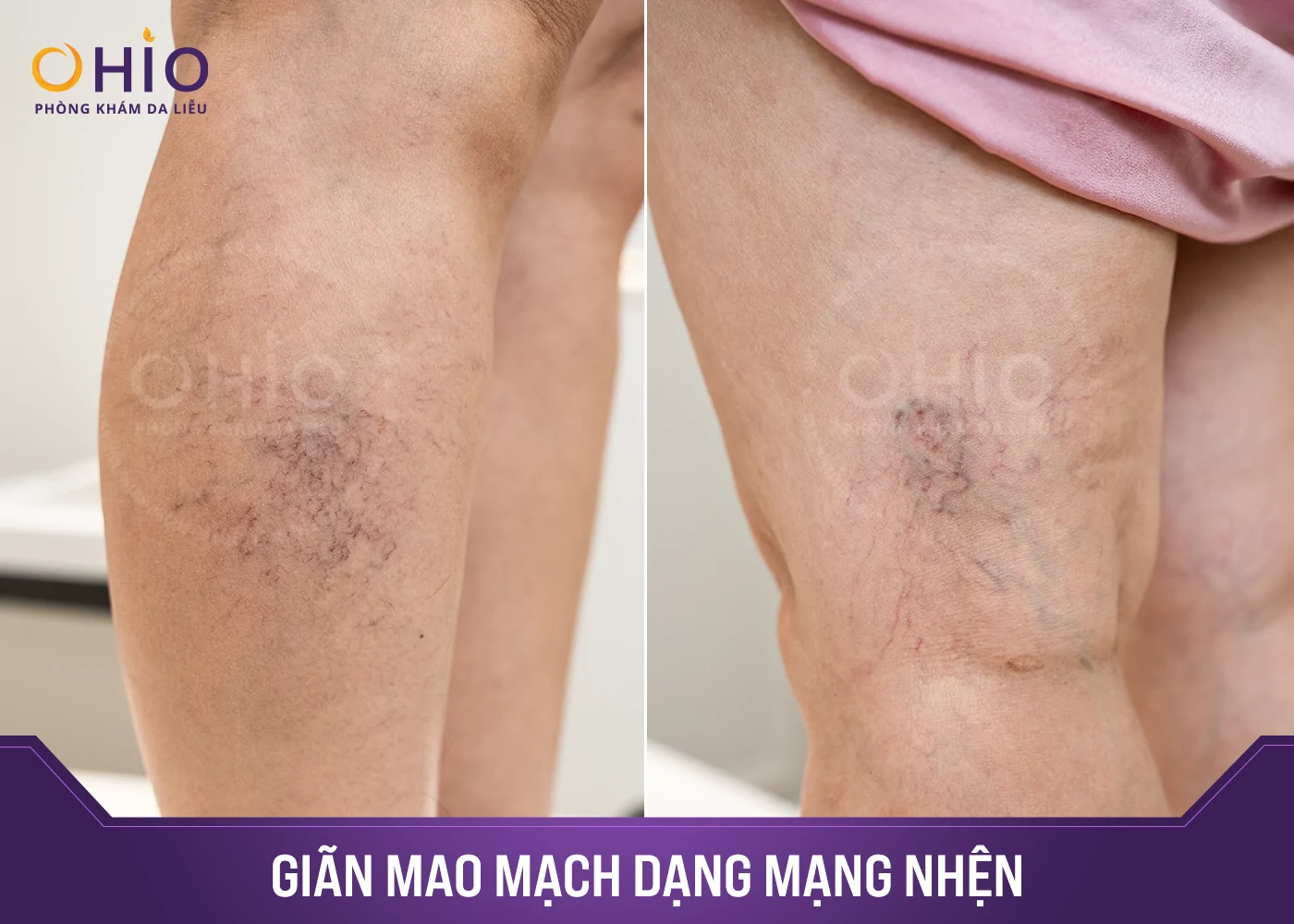 Dược sĩ Thu Hương: Trị giãn mao mạch - Tôi tin chọn OHIO - Phòng khám da liễu OHIO Dược sĩ Thu Hương: Trị giãn mao mạch - Tôi tin chọn OHIO