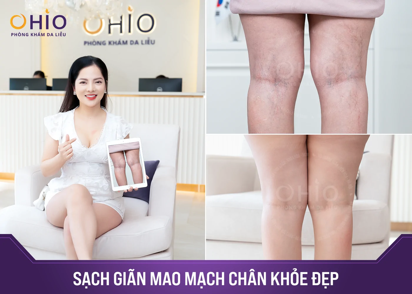 Dược sĩ Thu Hương: Trị giãn mao mạch - Tôi tin chọn OHIO - Phòng khám da liễu OHIO Dược sĩ Thu Hương: Trị giãn mao mạch - Tôi tin chọn OHIO