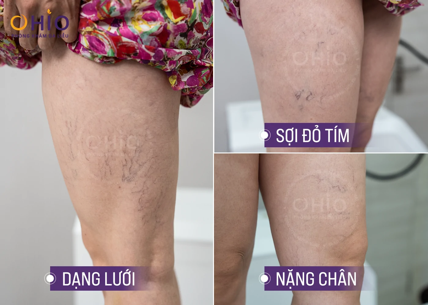 Doanh Nhân Thu Phương" thoát" giãn mao mạch thành công nhờ OHIO - Phòng khám da liễu OHIO các dạng giãn mao mạch chân