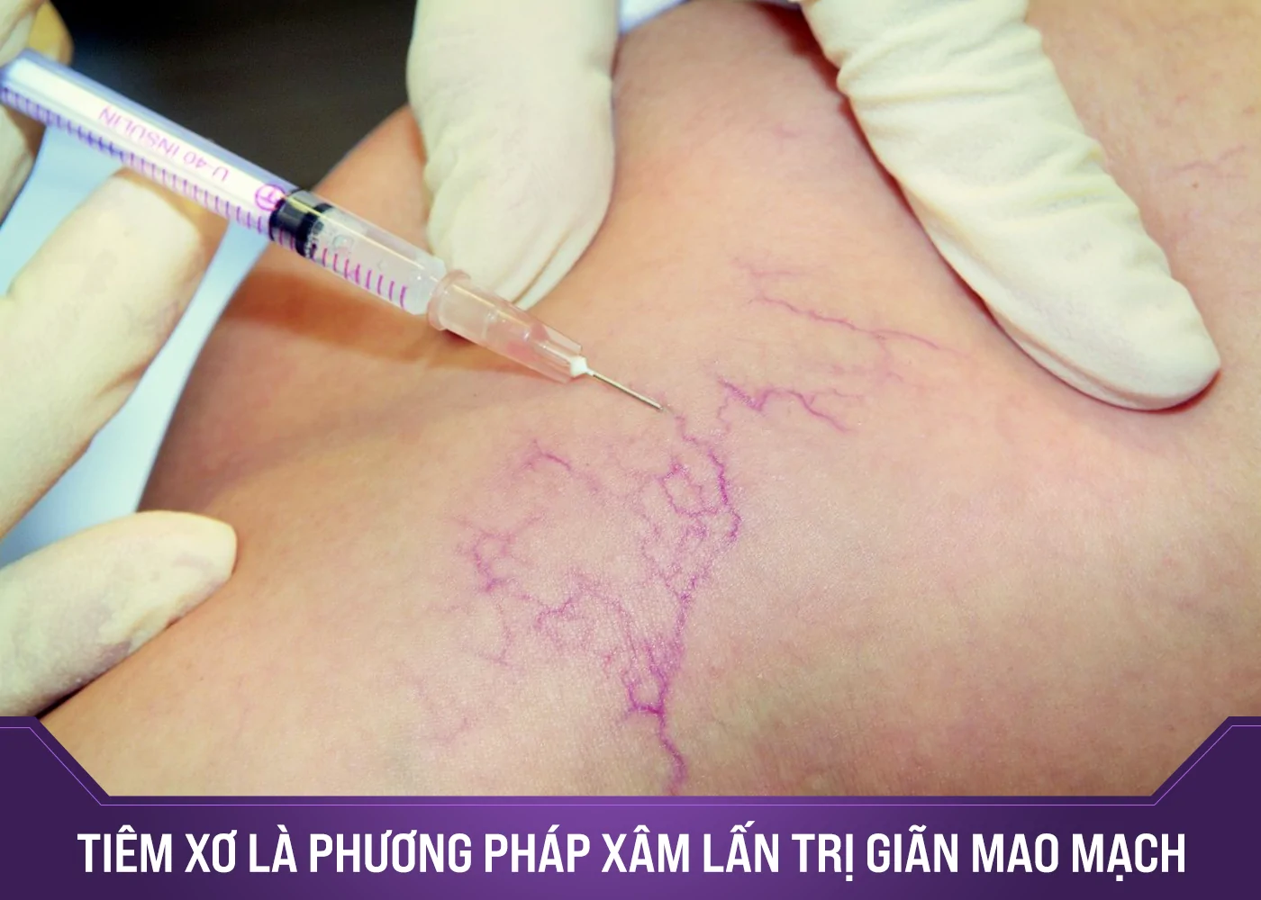 Doanh Nhân Thu Phương" thoát" giãn mao mạch thành công nhờ OHIO - Phòng khám da liễu OHIO Doanh Nhân Thu Phương" thoát" giãn mao mạch thành công nhờ OHIO