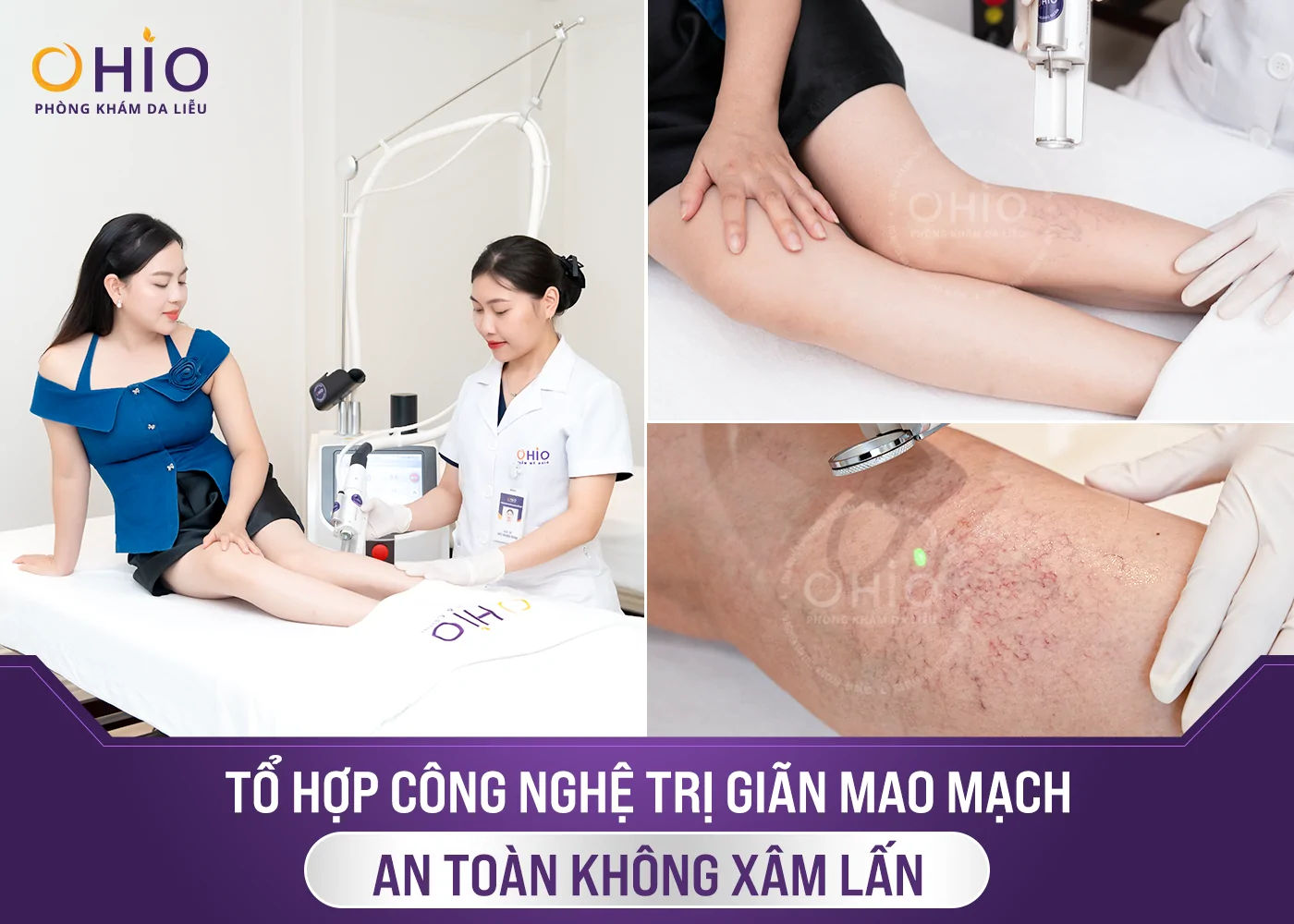 Doanh Nhân Thu Phương" thoát" giãn mao mạch thành công nhờ OHIO - Phòng khám da liễu OHIO Doanh Nhân Thu Phương" thoát" giãn mao mạch thành công nhờ OHIO