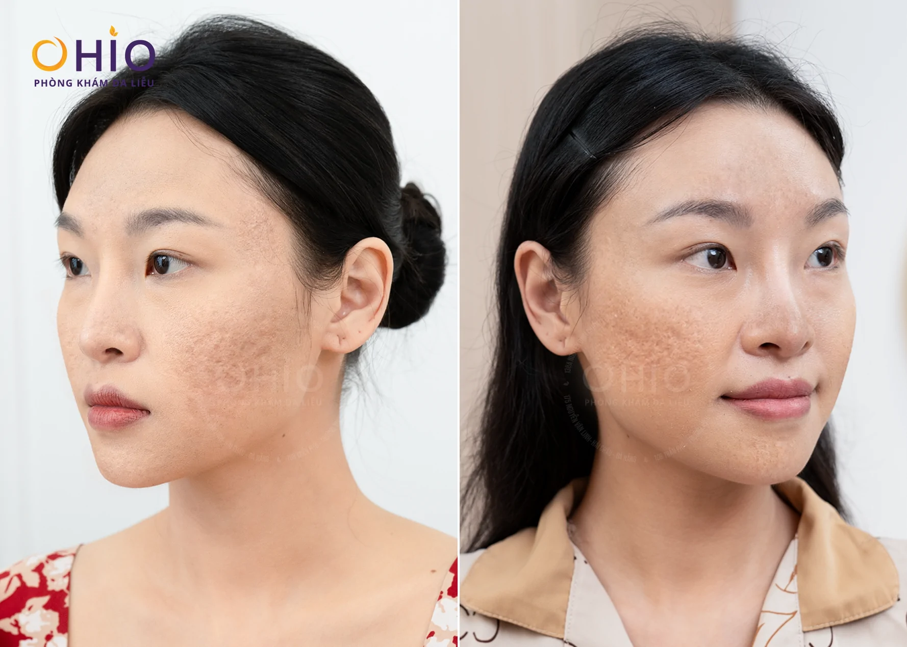 XÓA SẠCH SẸO RỖ, CHỊ BẠCH TUYẾT TÌM LẠI NHAN SẮC VÀ SỰ TỰ TIN TRÊN HÀNH TRÌNH KINH DOANH - Phòng khám da liễu OHIO XÓA SẠCH SẸO RỖ, CHỊ BẠCH TUYẾT TÌM LẠI NHAN SẮC VÀ SỰ TỰ TIN TRÊN HÀNH TRÌNH KINH DOANH
