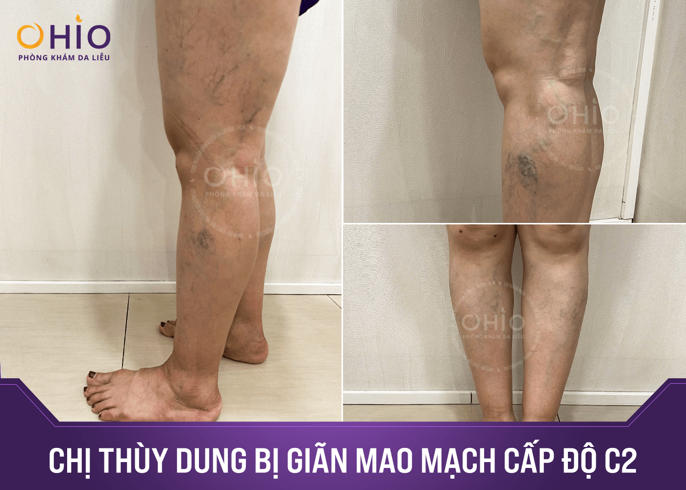 Hành trình Việt kiều Canada tìm lại đôi chân tự tin tại Phòng khám OHIO - Phòng khám da liễu OHIO Hành trình Việt kiều Canada tìm lại đôi chân tự tin tại Phòng khám OHIO