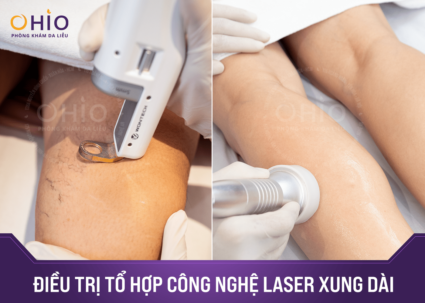 Hành trình Việt kiều Canada tìm lại đôi chân tự tin tại Phòng khám OHIO