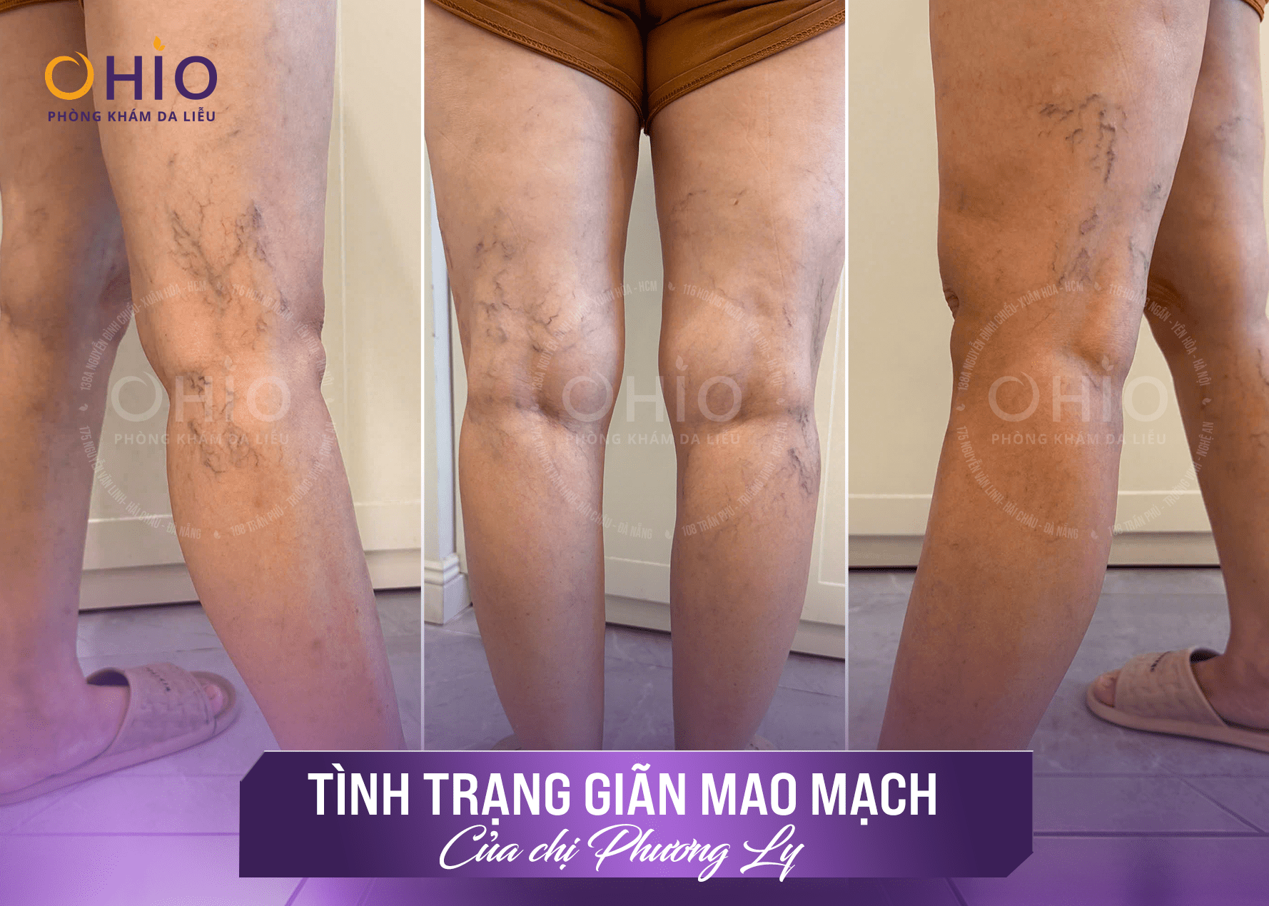 Giải pháp trị giãn mao mạch sau sinh giúp chị Phương Ly tự tin quay lại công việc - Phòng khám da liễu OHIO Giải pháp trị giãn mao mạch sau sinh giúp chị Phương Ly tự tin quay lại công việc