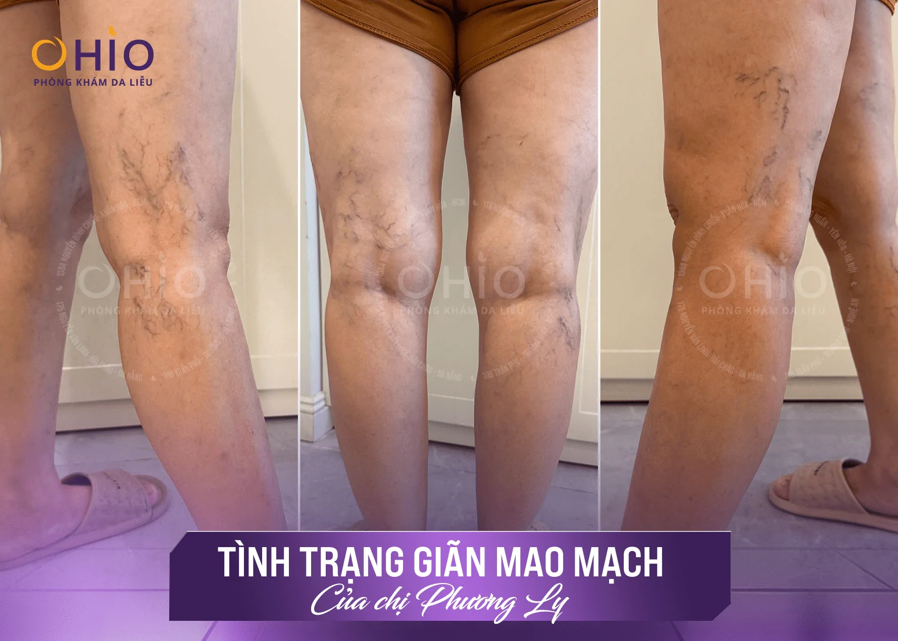 Giải pháp trị giãn mao mạch sau sinh giúp chị Phương Ly tự tin quay lại công việc - Phòng khám da liễu OHIO Giải pháp trị giãn mao mạch sau sinh giúp chị Phương Ly tự tin quay lại công việc