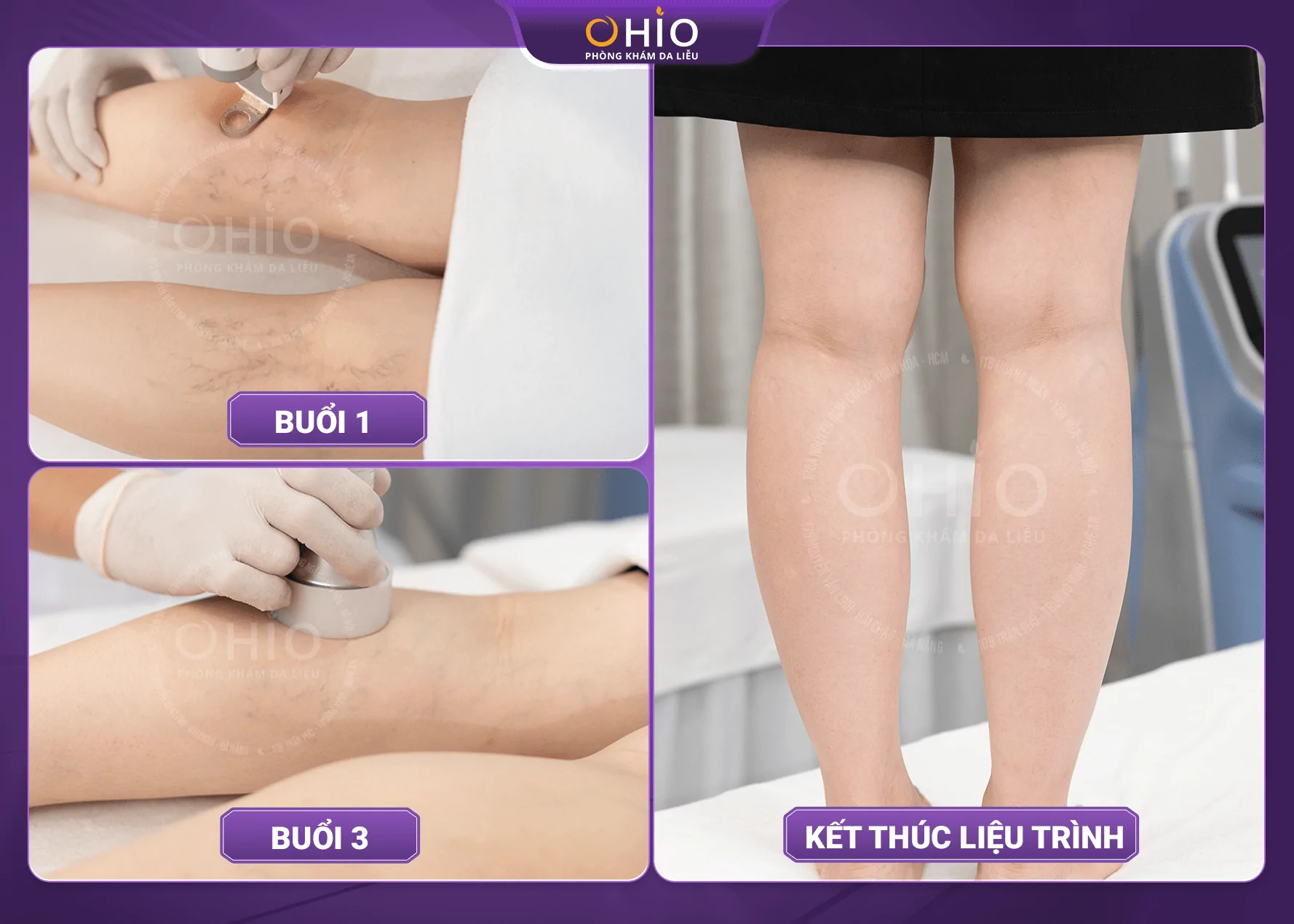 Giải pháp trị giãn mao mạch sau sinh giúp chị Phương Ly tự tin quay lại công việc - Phòng khám da liễu OHIO Giải pháp trị giãn mao mạch sau sinh giúp chị Phương Ly tự tin quay lại công việc